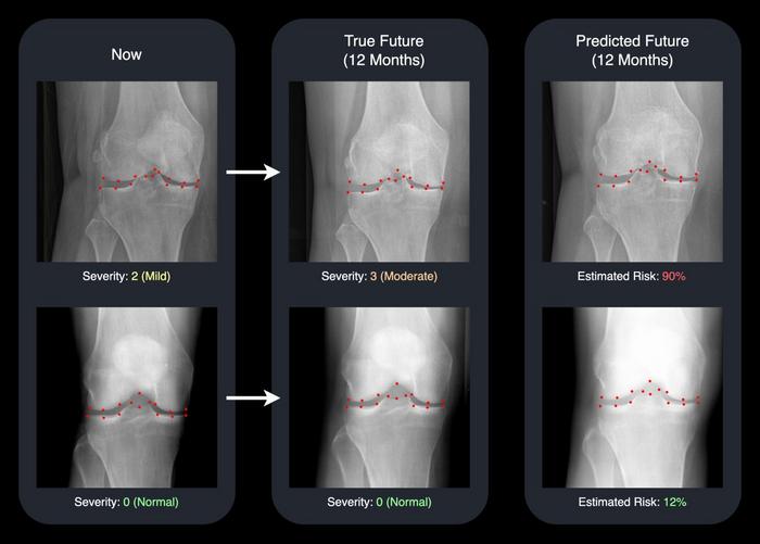 AI predicts osteoarthritis progression