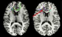Disorganized Tracts in Periventricular Nodular Heterotopia