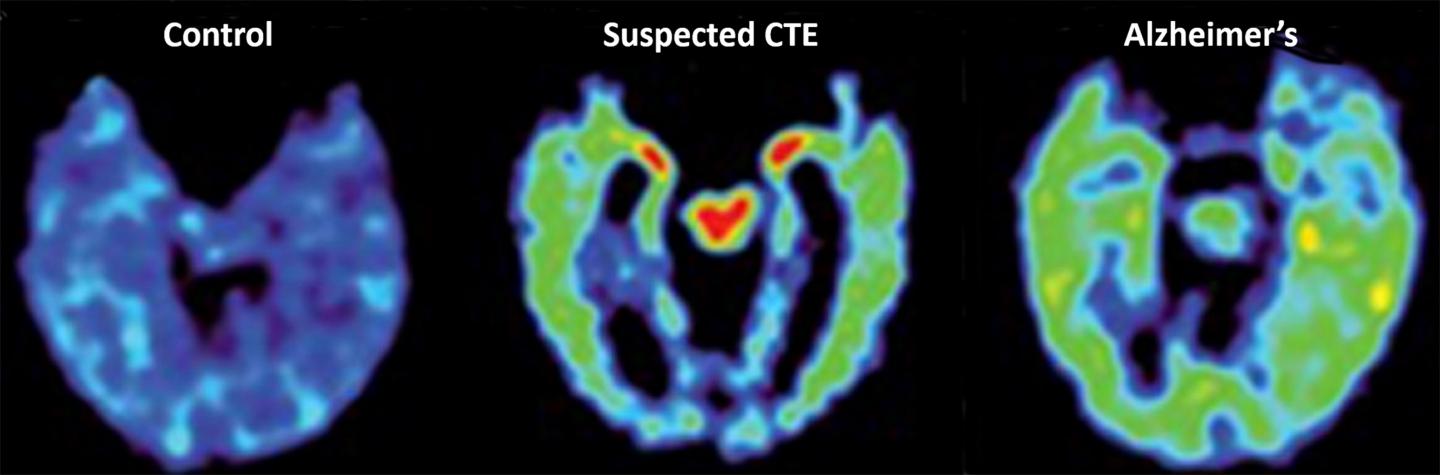 PET Brain Scans