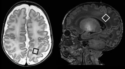 White Matter