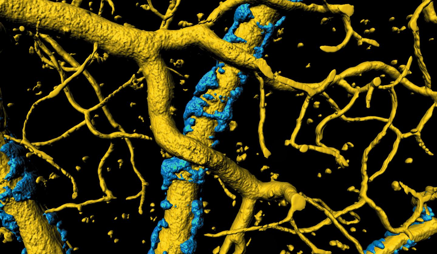 Amyloid