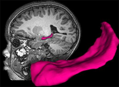 Hippocampal Volume Shrinks