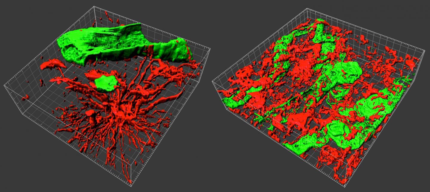 3D biopsies to better understand brain tumors