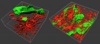 3D biopsies to better understand brain tumors