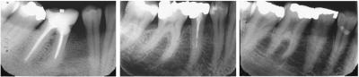Dental X-Rays Can Predict Fractures