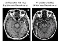 FTLD Patient Brain Images