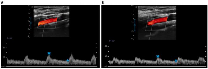 Hemodynamic characteristics of the internal carotid artery (ICA) in a 24-year-old male participant at baseline and after 12 h of head-down tilt bed rest (HDT BR), derived from ultrasound Doppler imaging.