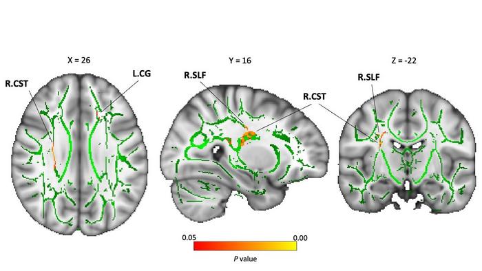 Structural differences in the white matter (WM) between neglected and typically developing (TD) groups using DTI (TBSS).