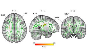 Structural differences in the white matter (WM) between neglected and typically developing (TD) groups using DTI (TBSS).