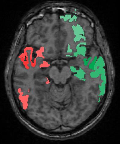 Brain Map of Neural Circuits Encoding Risk-Taking Bias