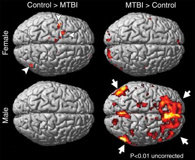 Sex Differences; Initial Study