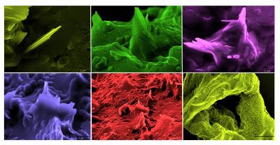 Cholesterol Crystals
