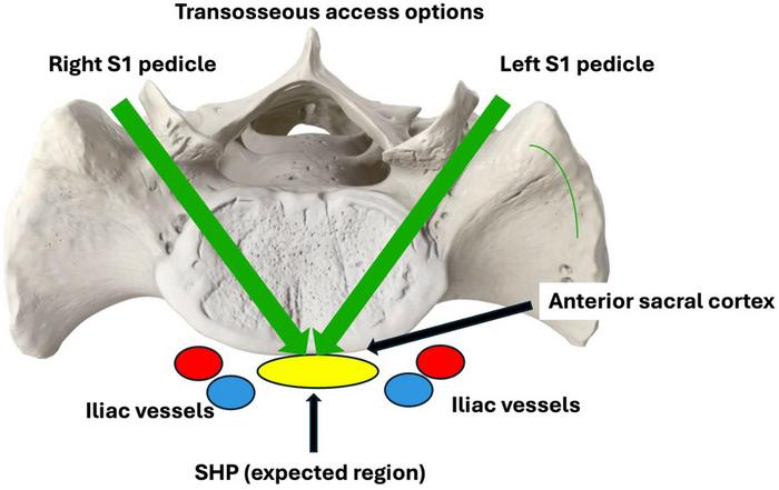 Schematic representation of bilateral posterior transosseous S1 pedicle access trajectories toward the superior hypogastric plexus region