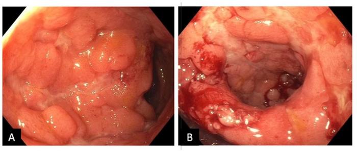 Inflammatory disorders of the ileal pouch in a patient with concurrent primary sclerosing cholangitis and ulcerative colitis.