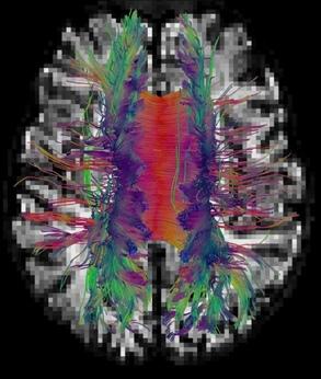 Figure 1 Bundles of Neural Fibers Reconstructed from Dmri Measurements