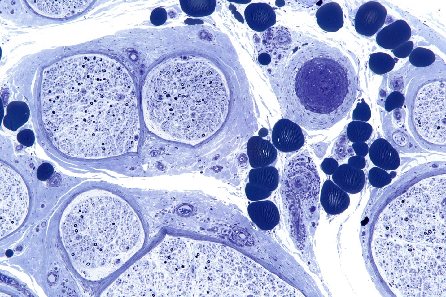 Peripheral Neuropathy