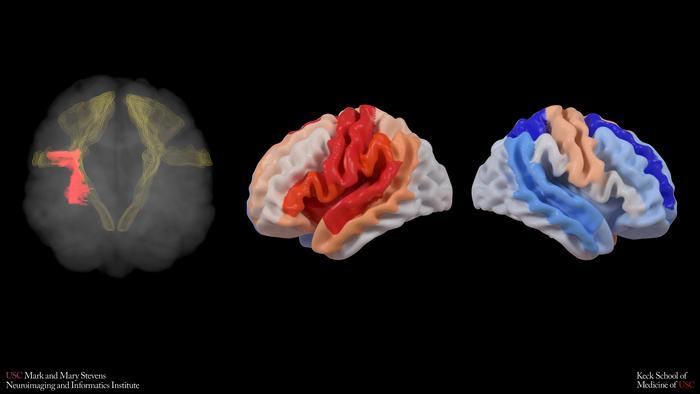 stroke and brain aging