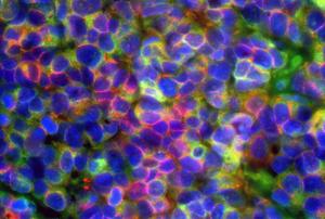 Prostate cancer cells