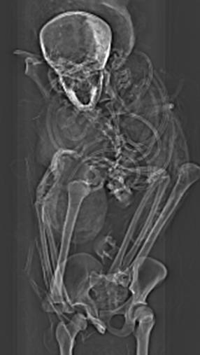 X ray