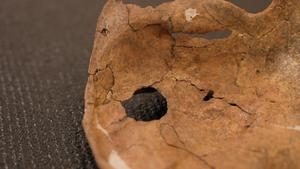 A close-up photograph of the hole in the scapula.