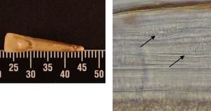 Example of smoking damage in an archaeological tooth. The magnified image shows variations in the tooth's cementum rings from smoking