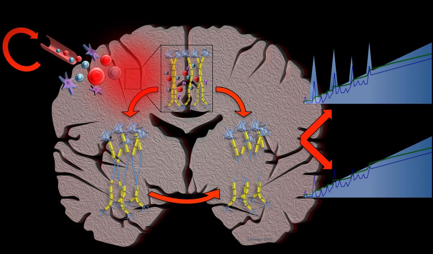Computational Simulations Suggest Multiple Sclerosis is a Single Disease