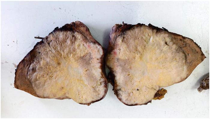 Combined hepatocellular-cholangiocarcinoma: A rare and challenging diagnostic entity – A Case Report