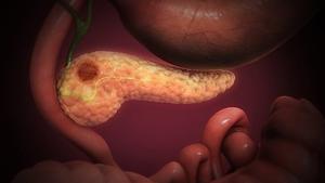 Pancreatitis rates are decreasing globally, but at uneven rates