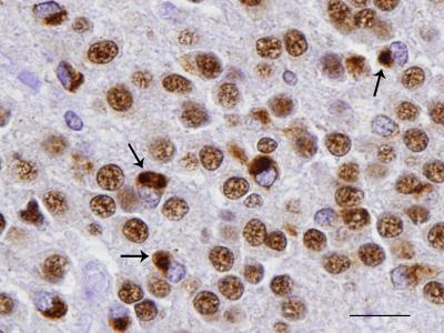 Misfolded TDP-43 Proteins in Neurons of Brain Tissue