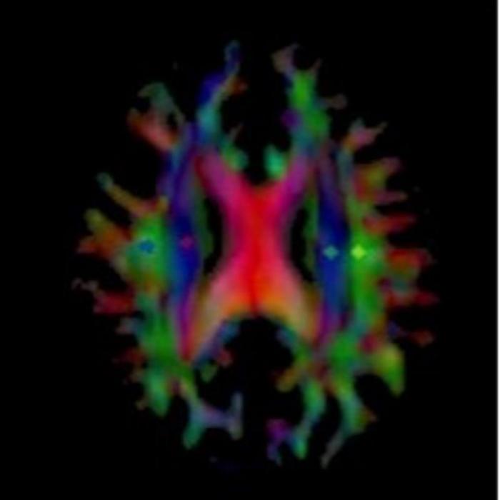 Map of an Alzheimer's patient's brain showing the diffusion of water as part of glymphatic flow