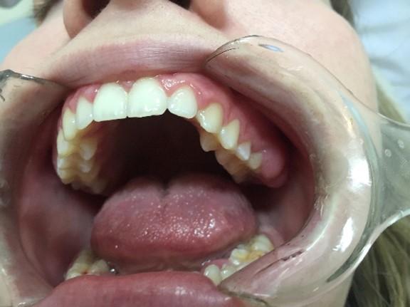 Pathogens in the mouth induce oral cancer