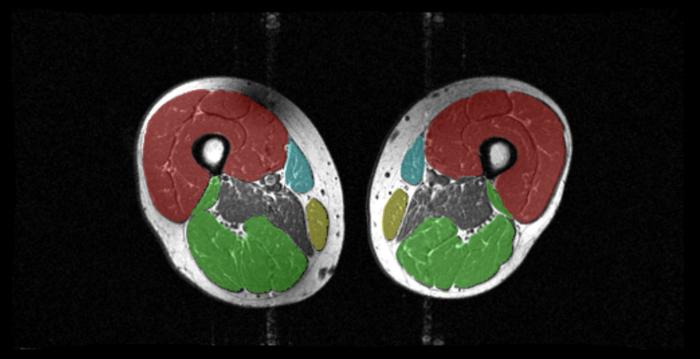 MRI image of thigh muscles