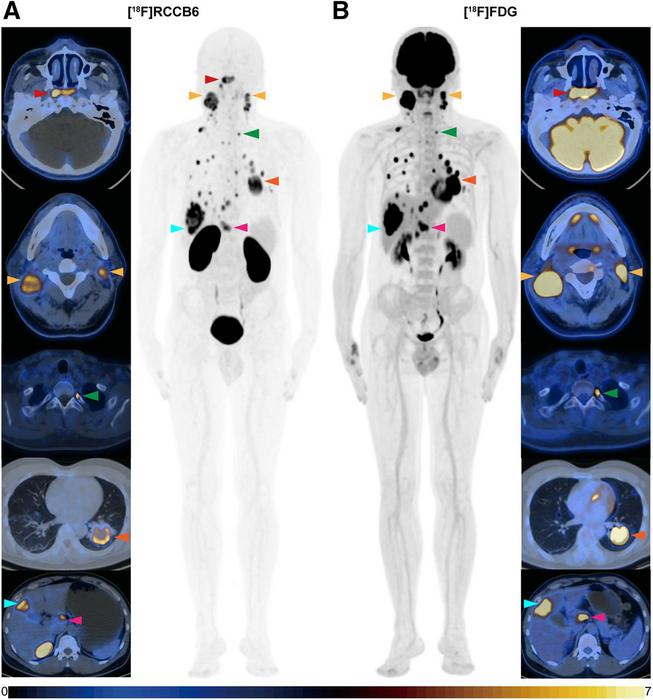 [18F]RCCB6 and 18F-FDG PET/CT imaging in patient with advanced NPC.