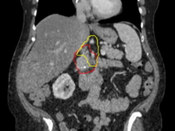 Image of a what is targeted with radiation. Red represents the pancreatic tumor, which is contacting with a major nearby artery. Yellow represents the Baltimore Triangle, which is now targeted in all patients, in addition to red volume.