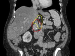 Image of a what is targeted with radiation. Red represents the pancreatic tumor, which is contacting with a major nearby artery. Yellow represents the Baltimore Triangle, which is now targeted in all patients, in addition to red volume.