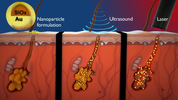 Acne Nanoparticle