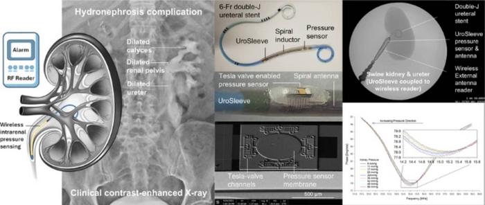 UroSleeve enables wireless intrarenal pressure sensing.