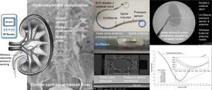 UroSleeve enables wireless intrarenal pressure sensing.