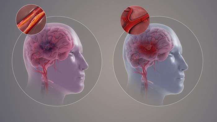 Neuroform Atlas Stent-assisted coiling approach from intracranial aneurysms