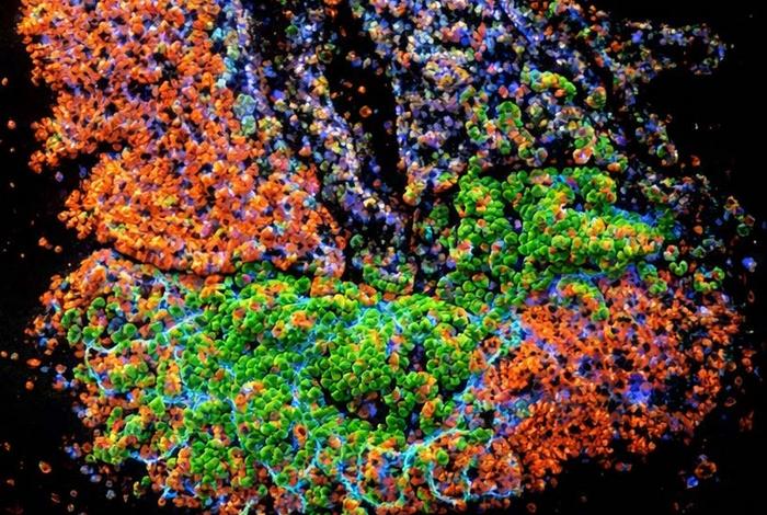 Enhanced image showing where genes are active in colon tissue, revealing neutrophils located close to pre-cancerous epithelial cells