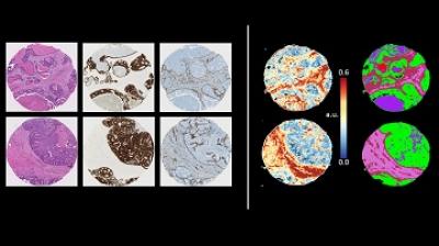 Two Breast Biopsies