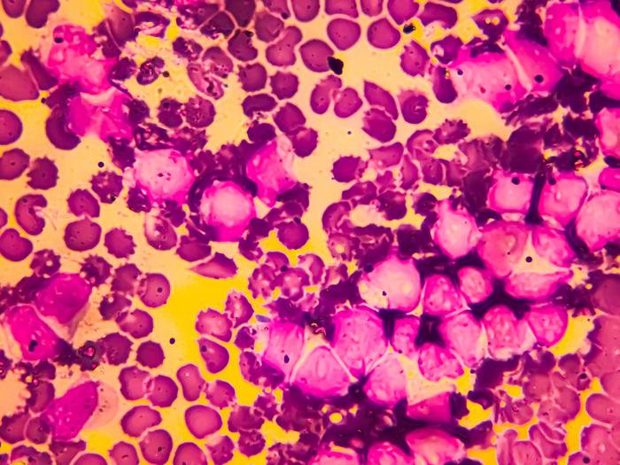Multiple Myeloma Cells