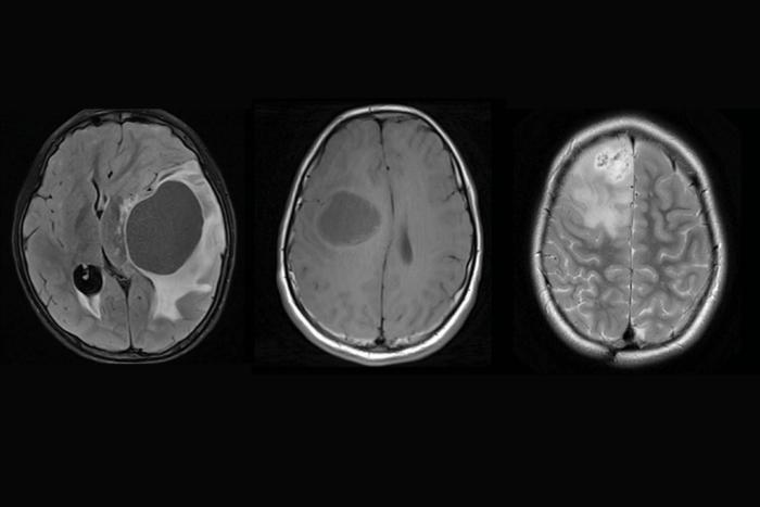 Discovery of unique brain tumour subtypes offers hope for targeted glioma therapies