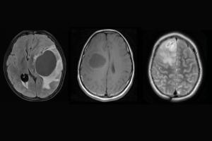 Discovery of unique brain tumour subtypes offers hope for targeted glioma therapies