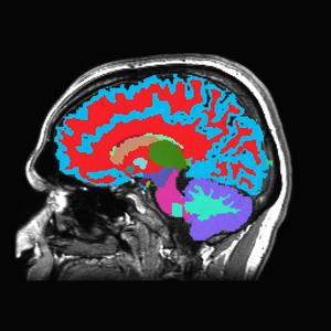 MRI brain scan