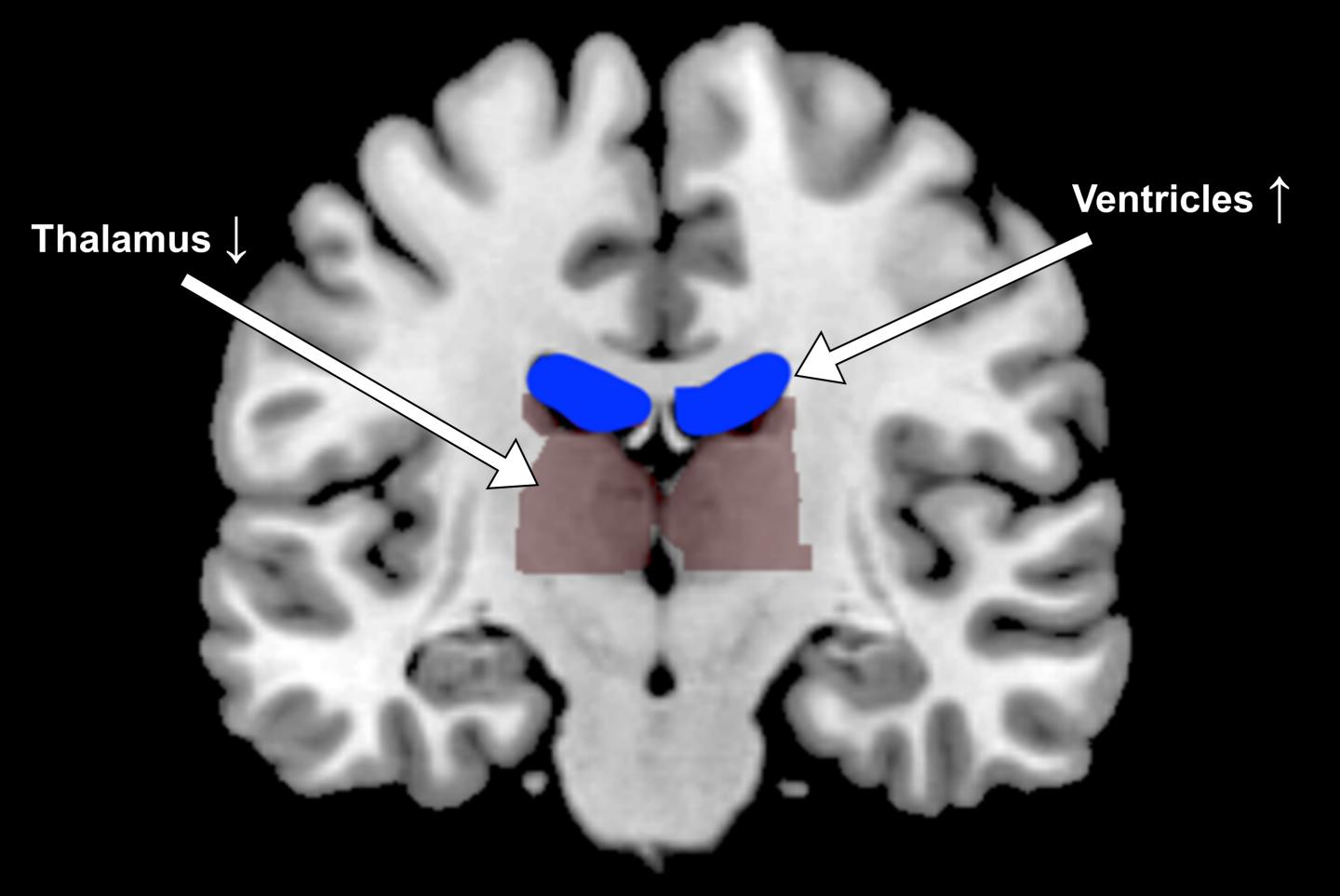 Dehydration Brain Shape Changes