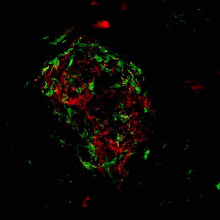 Age-related Macular Degeneration