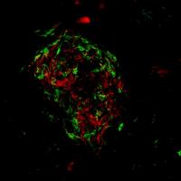Age-related Macular Degeneration
