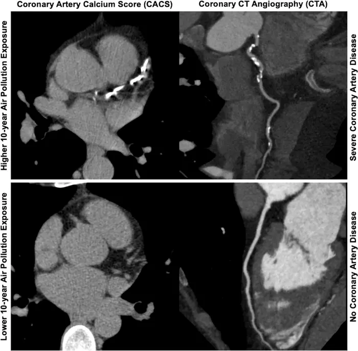 Axial images from unenhanced calcium score cardiac CT (left) and curved planar reformation images from CT angiography (right).