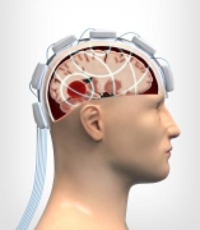 Strokefinder Quickly Differentiates Bleeding Strokes From Clot-Induced Strokes